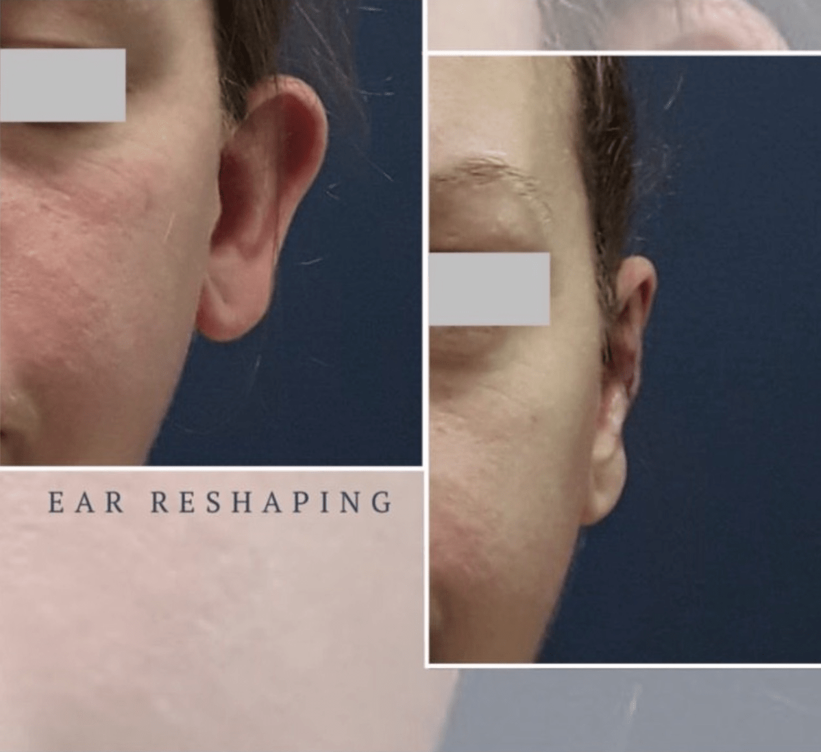 Before and after photos showing ear reshaping otoplasty results