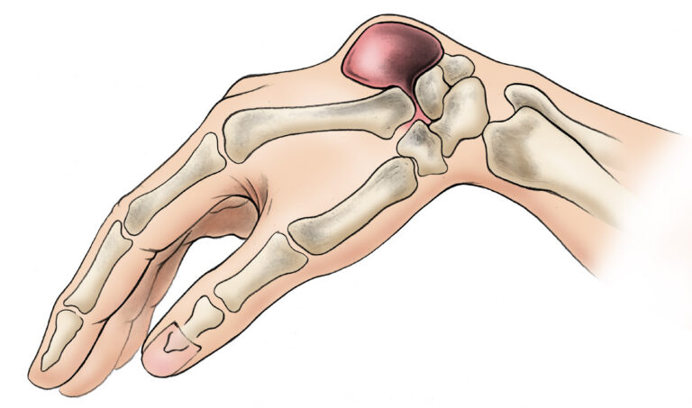 Ganglion cyst lump on the wrist