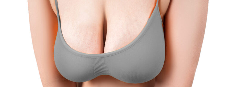 Woman considering a breast lift to address sagging breast tissue