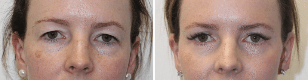 CC-Female-Upper-Eyelid-Blepharoplasty-to-restore-youthfulness-and-improve-visual-fields-1-1