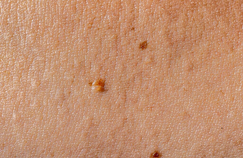 skin tag