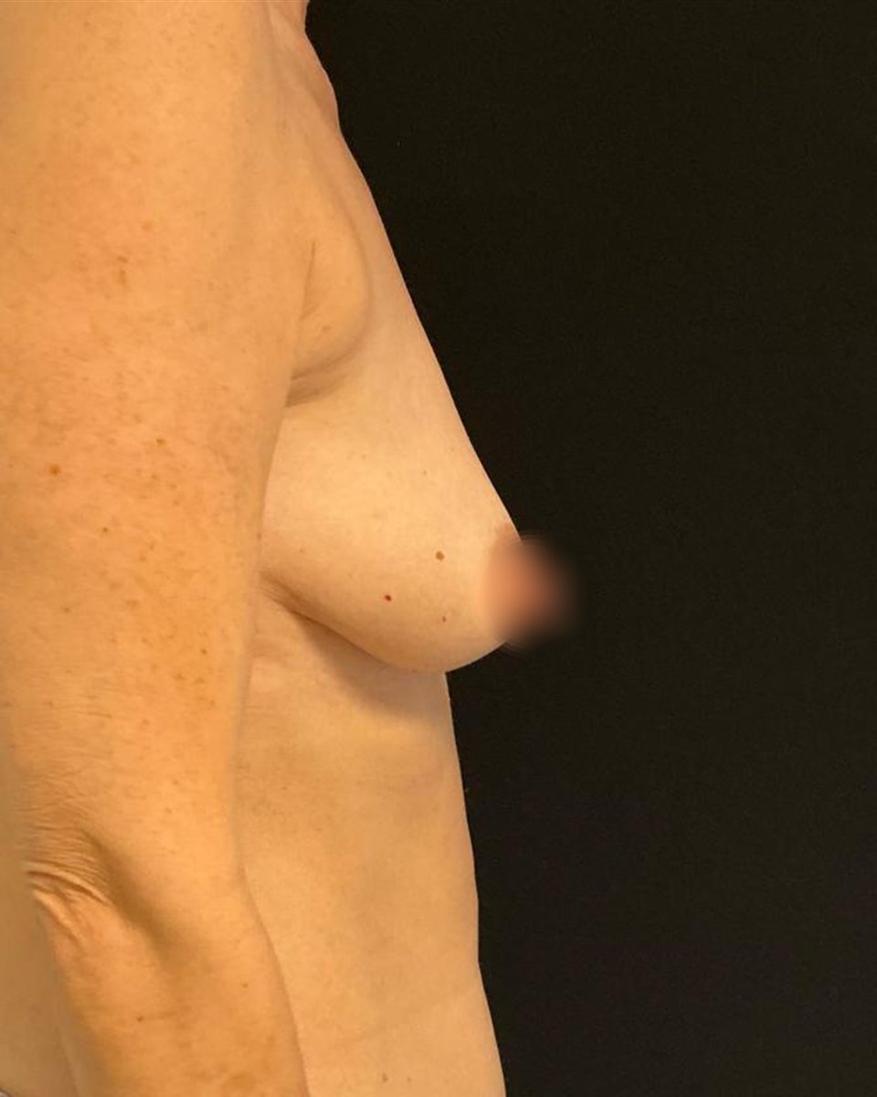 Augmentation and lift, before surgery
