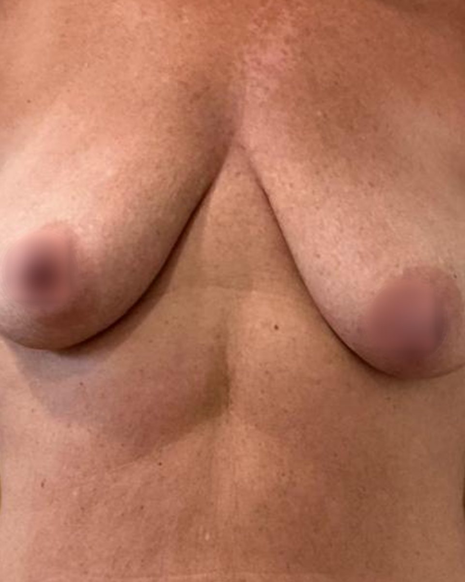 Augmentation and lift, before surgery