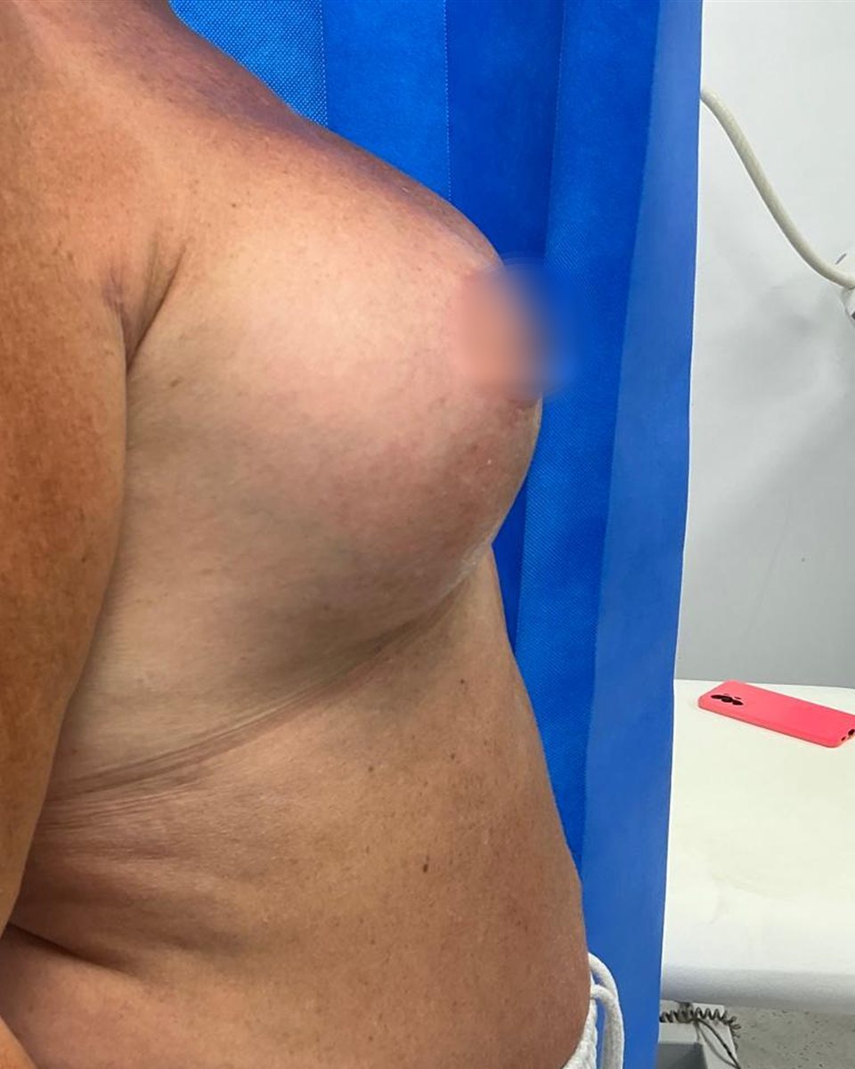 Augmentation and lift,
