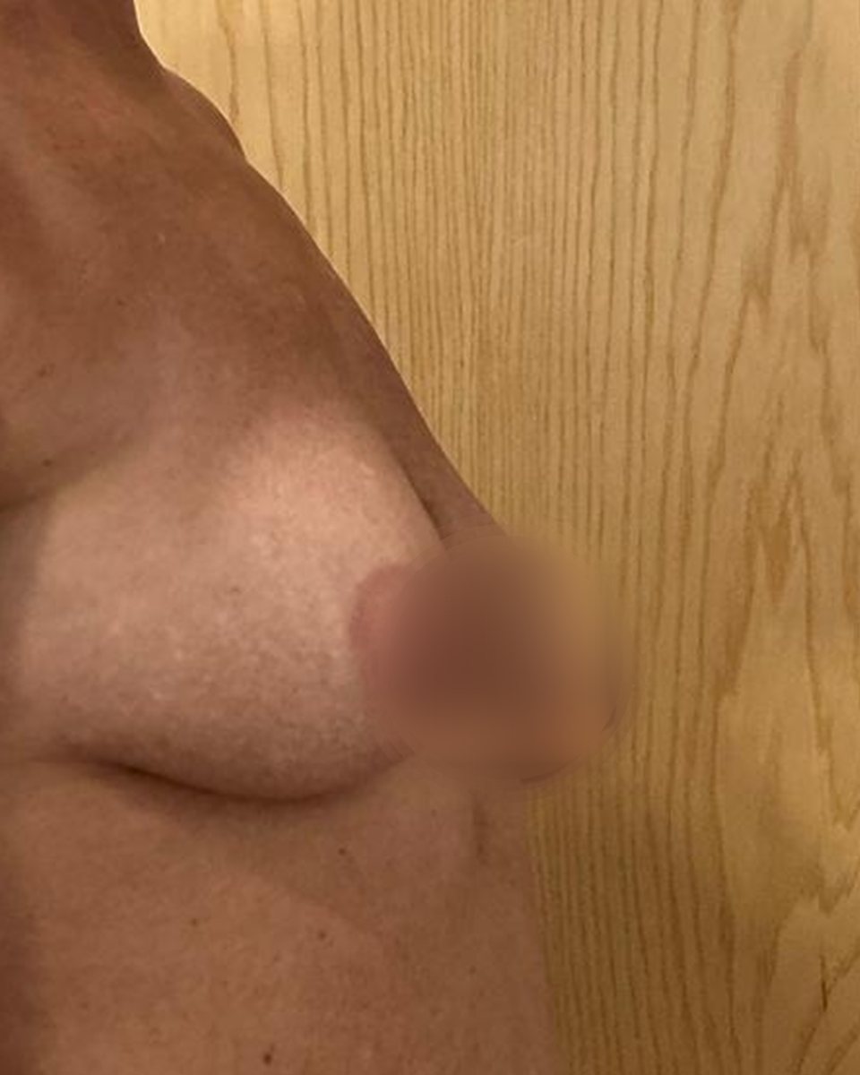 Augmentation and lift, before surgery