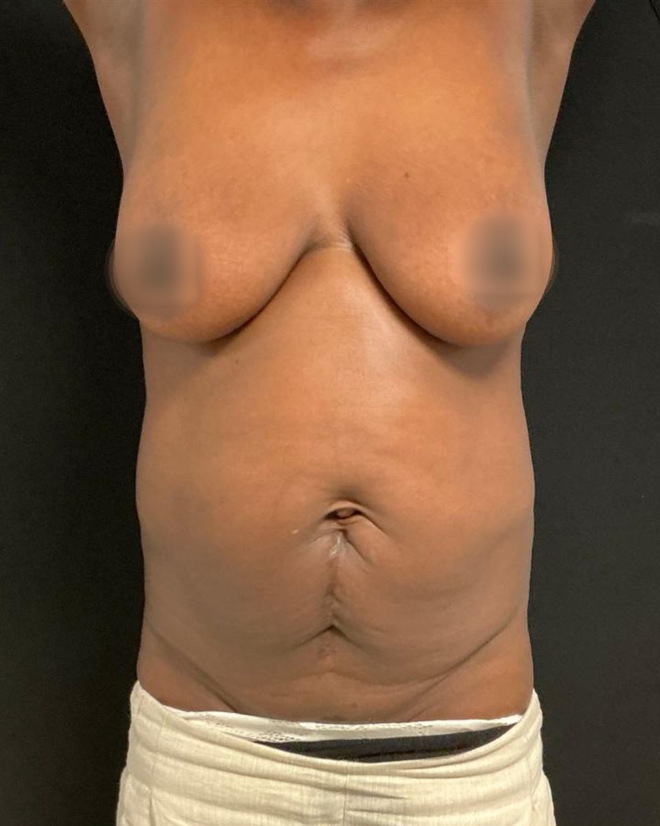 Breast lift, before surgery