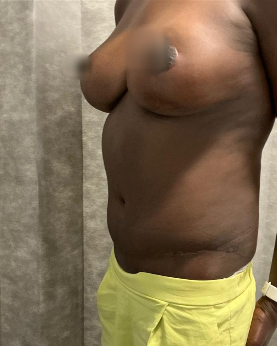 Breast lift,