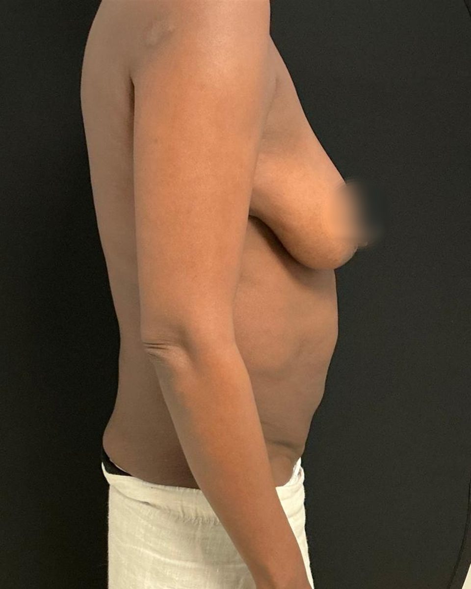Breast lift, before surgery