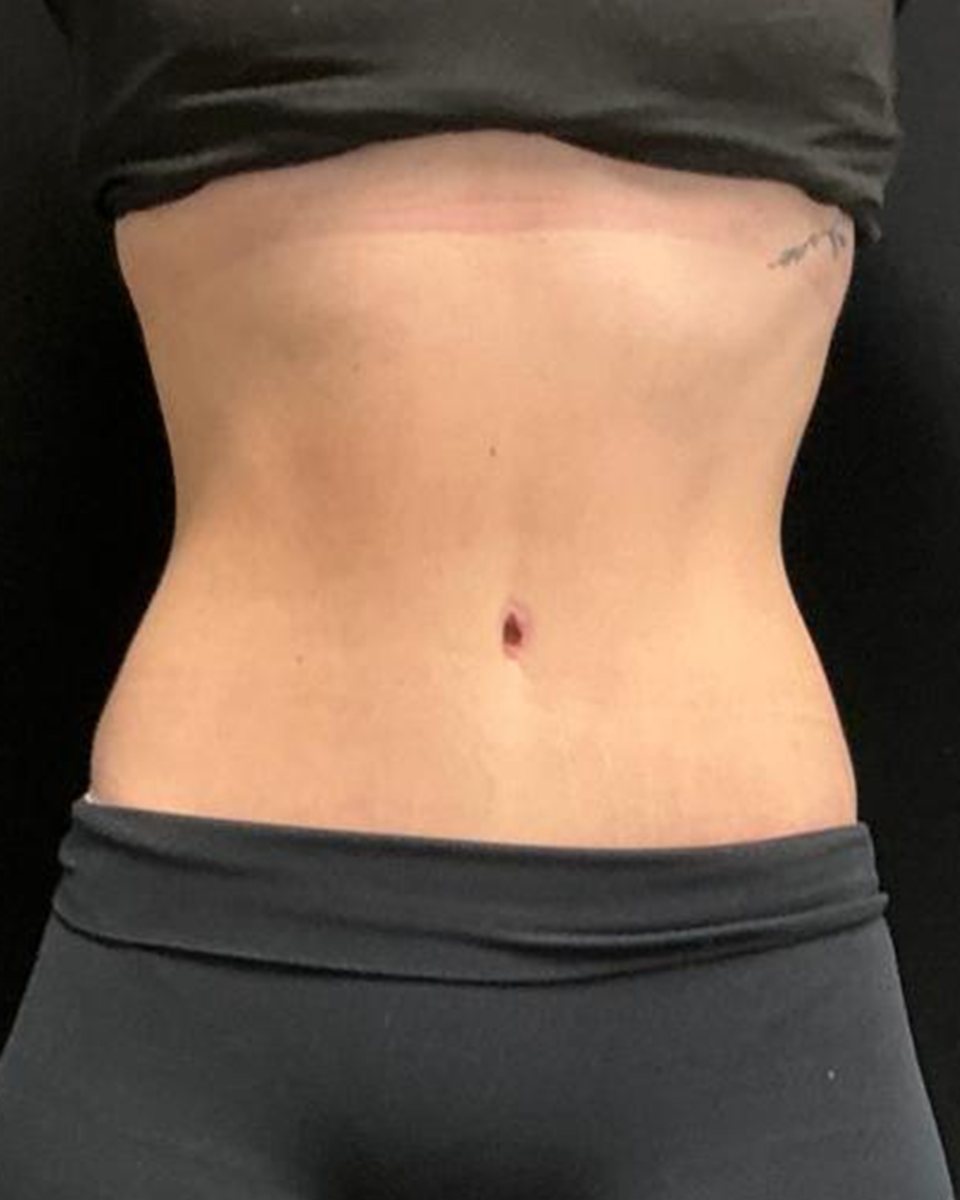 Tummy tuck,