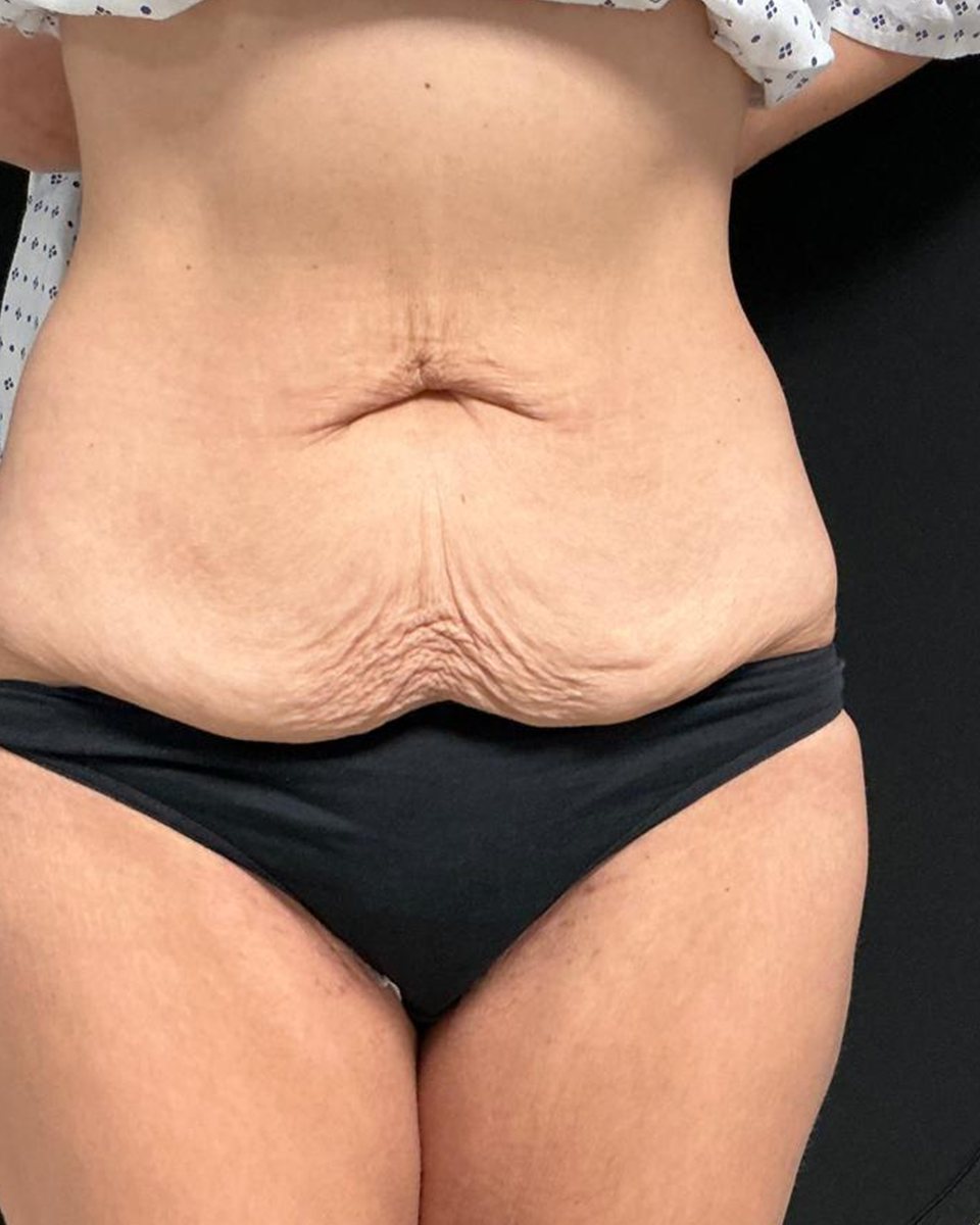 Tummy tuck, before surgery