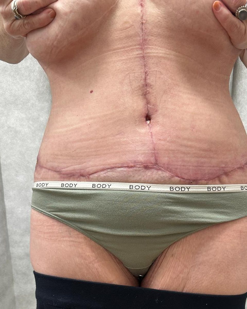 Tummy tuck,