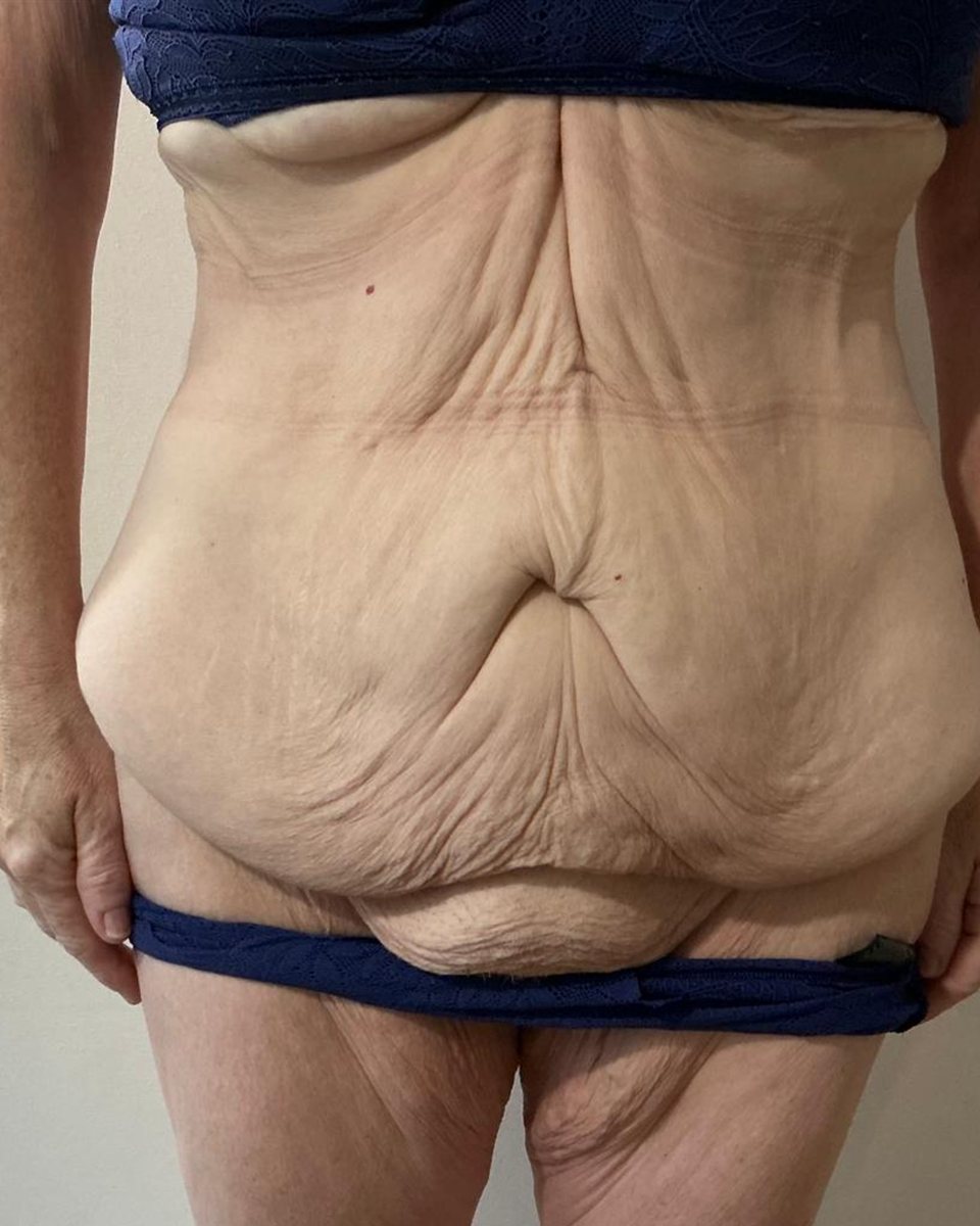 Tummy tuck, before surgery