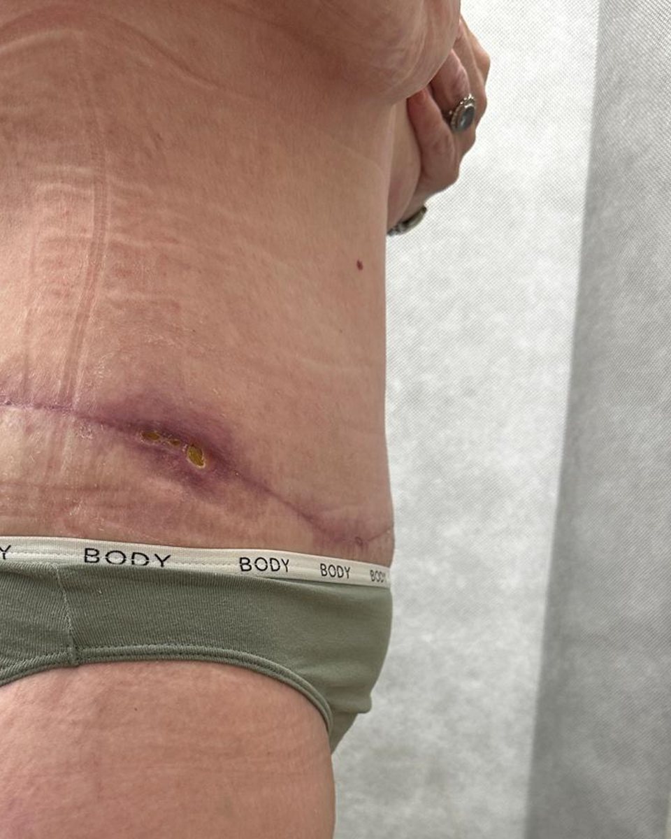 Tummy tuck,