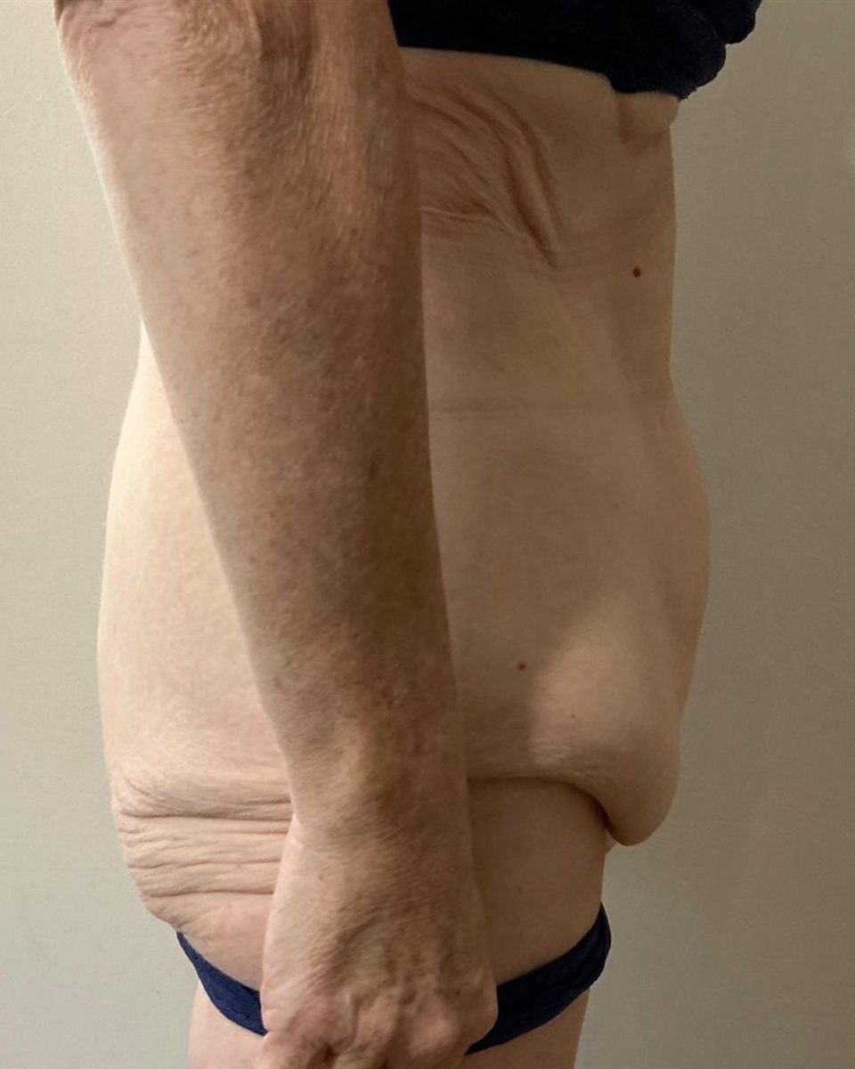 Tummy tuck, before surgery